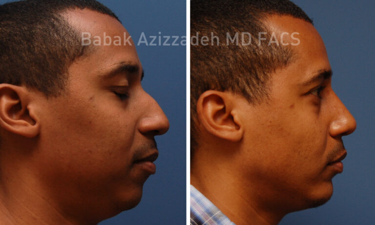 Male-Rhinoplasty-3-Before-After-Azizzadeh-Beverly-Hills